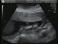 Baby Evangelina Castellano