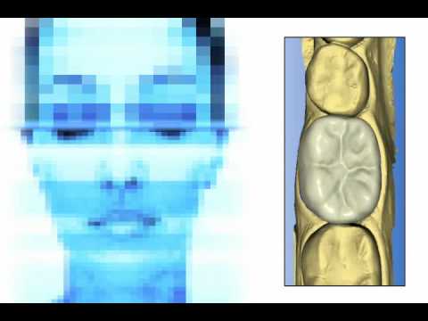 CEREC Biogeneric Software - Available Worldwide May 2010