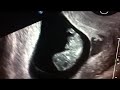 9 week ultrasound