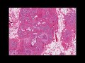 Histopathology Pancreas--Cystic fibrosis