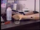 vietortho - Tv report about VIETORTHO's myoelectric arm prosthesis. VIETORTHO is an orthopedic center, in French Hospital of HANOI, VIETNAM. Bao cao tren truyen hinh ve ...
