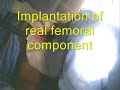 Hip resurfacing video India Hip resurfacing video India