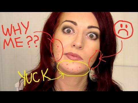 ACNE FACE CHARTS & MAPPING? Hormonal Acne & More Clear Acne Quick Tips! AQA#3