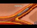 Angioplasty Angioplasty