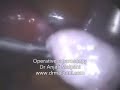 Polikisitk overde operatif laparoskopi