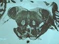 Medulla-Pons Transition