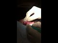 Professional Cyst Draining