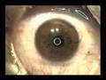 Re: Laser - Eye Surgery - lasik Re: Laser - Eye Surgery - lasik