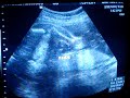 ULTRA-SOM DO BEBÊ DE ROSYLAINE E WASHIGTON - 24 SEMANAS