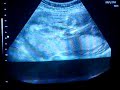 ULTRA-SOM DO BEB� DE ROSYLAINE E WASHIGTON - 24 SEMANAS