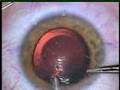 Visian Implanted Contact Lens Insertion