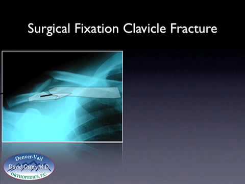 This video discusses the surgical and non-surgical management of clavicle This video discusses the surgical and non-surgical management of clavicle