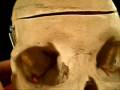 videos de Human Geriatric Skull  with Dental Anomaly