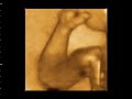 3d-4d-ultrasonografia-braco-feto