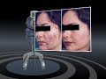 Acne Patients comment on ISOLAZ treatment