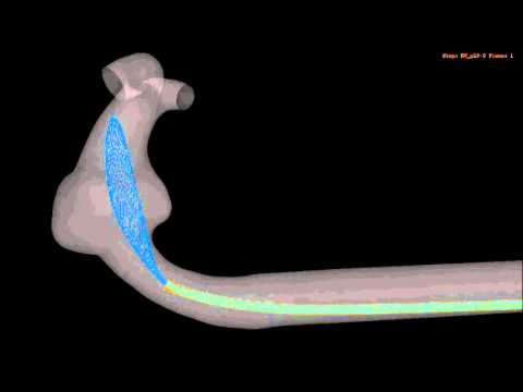 micro catheter - FEA based virtual deployment of a flow diverter (FD) into a patient specific fusiform intracranial aneurysm. Deployment procedure from the movie: After crimp...