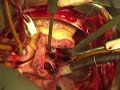 Removal of RA Myxoma on beating heart 3