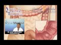 Informacion bypass gastrico.avi