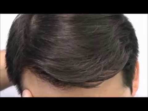 how to do your own hair transplant