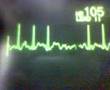 ECG Video: Atrial Fibrillation
