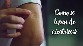 Fica a Dica - Como se livrar de cicatrizes?