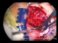 Left Suboccipital Craniotomy