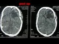 Brain tumors-meningiomas cerebral convexity-treatment-dr suresh dugani/HUBLI //INDIA