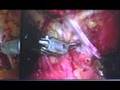 What are the Types of Prostate Cancer Surgery? featuring Drs. Tewari and Schlegel (ProstateCancerMD)