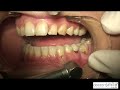 Hard Tissue Neck caries.mpg