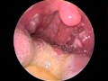 Amigdalitis aguda