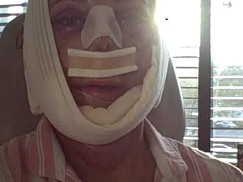 My Facial Plastic Surgery Blog - Recovery Day 2