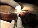 Follicular Unit Extraction (FUE) VS hair transplant Follicular Unit Extraction (FUE) VS hair transplant
