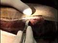 Follicular Unit Extraction (FUE) VS hair transplant
