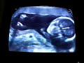 19 weeks ultrasound - big 