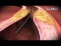 Atherosclerosis is the condition in which an artery wall thickens as the result of a build-up of fatty materials such as cholesterol.It most commonly becomes seriously symptomatic when interfering with the coronary circulation supplying the heart or cerebral circulation supplying the brain, and is considered the most important underlying cause of strokes, heart attacks, and most cardiovascular diseases, in general. A stent is a man-made 'tube' inserted into a natural passage/conduit in the body to prevent, or counteract, a disease-induced, localized flow constriction. Stents are used to counter narrowing of arteries due to plaque deposition and hardening.