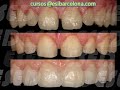 MASTER EN ESTÉTICA DENTAL. Barcelona España 2/2.