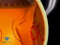 Scleral Buckling: Drainage Of Subretinal Fluid VR1 Basic Tec