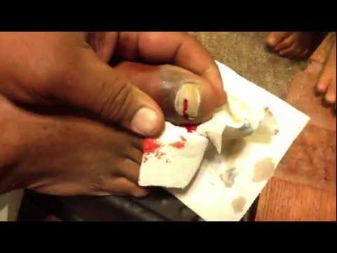 how to relieve pressure under a fingernail