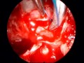 PRLoma - Sphenoid Ostium Access PRLoma - Sphenoid Ostium Access