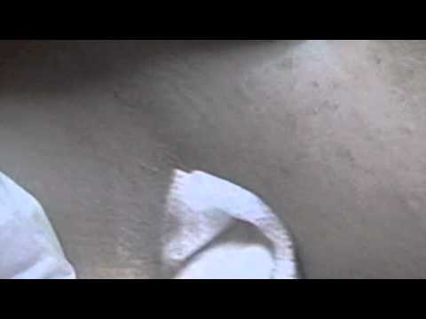 how to remove skin tags nhs