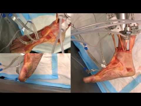 how to measure mds