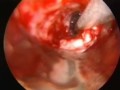 Metallic airway stenting for maliganant right main stenosis Metallic airway stenting for maliganant right main stenosis