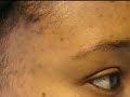 The Acne Practice (intro) The Acne Practice (intro)