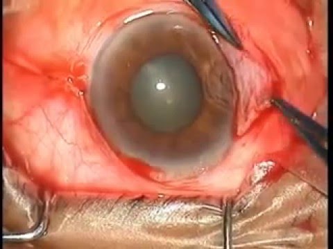 how to cure pterygium