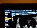 brouchoud 9 weeks with heart beats