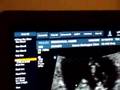 brouchoud 9 weeks with heart beats