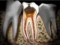 Caries