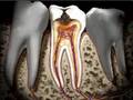 Caries