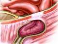 PreOp® Patient Education Hernia Repair - Inguinal (Open) V