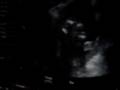 Baby Girl U/S